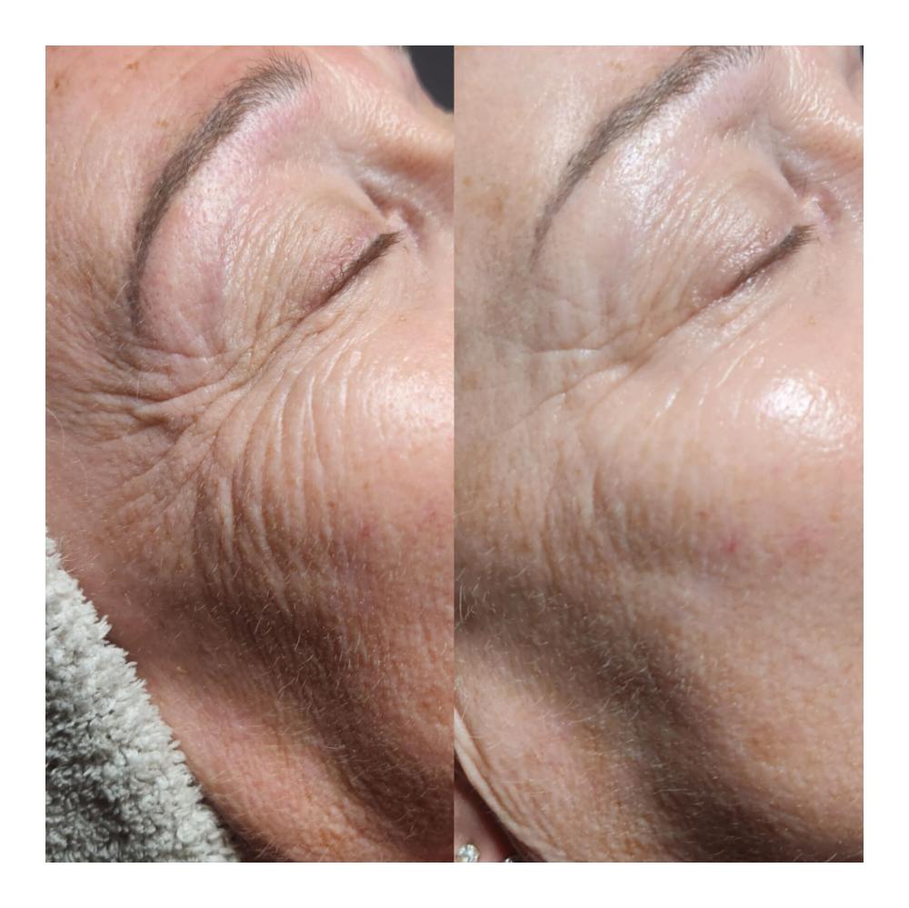 soin-anti-age-avant-apres-visage-myl-et-une-beaute-beville-le-comte.jpg